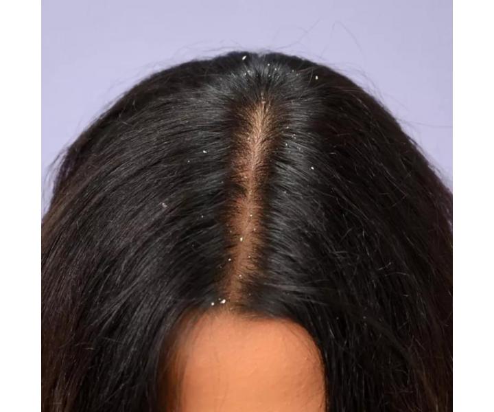 Zklid�uj�c� s�rum na poko�ku hlavy proti lup�m Schwarzkopf Professional BC Bonacure Anti-Dandruff Serum - 100 ml